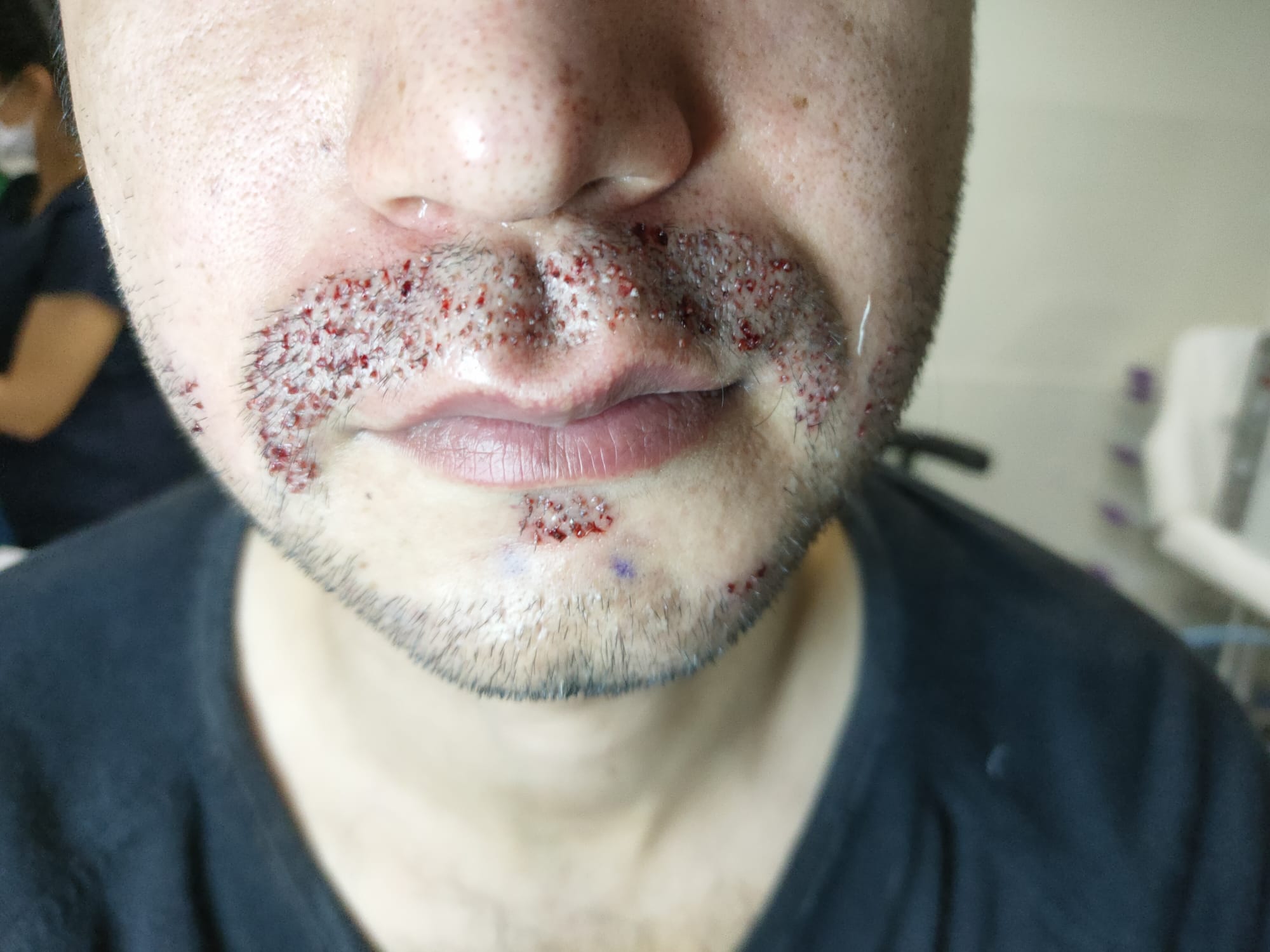 Bıyık Ekimi: İnce ve Seyrek Bıyıklara Son Verin